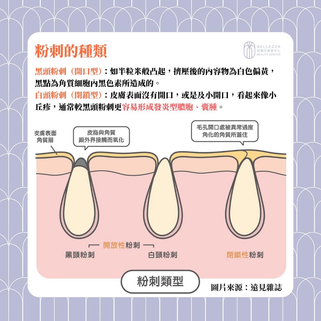 【美容小教室】與 粉刺 長期抗戰,不可不知的粉刺大小事! - 蓓儷莎美學中心 Bellezza Beauty Center
